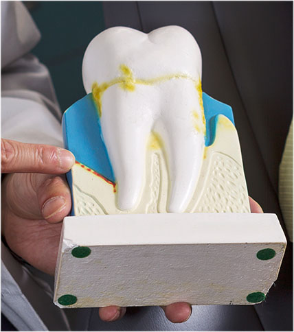 Hand holding a dental model of a tooth and pointing at it.